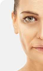 Anti Wrinkle Treatments — Before