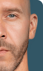 Hydra Facial — After