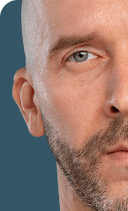 Hydra Facial — Before