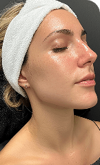 Laser Skin Treatments — After