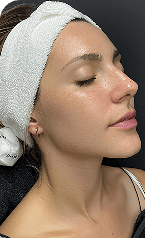Laser Skin Treatments — Before