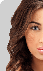 Pigmentation Treatment — Before