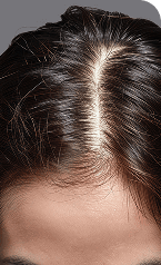 Scalp Analysis — After