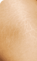Scar Treatment — Before