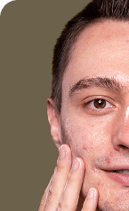 Signature Facial — Before