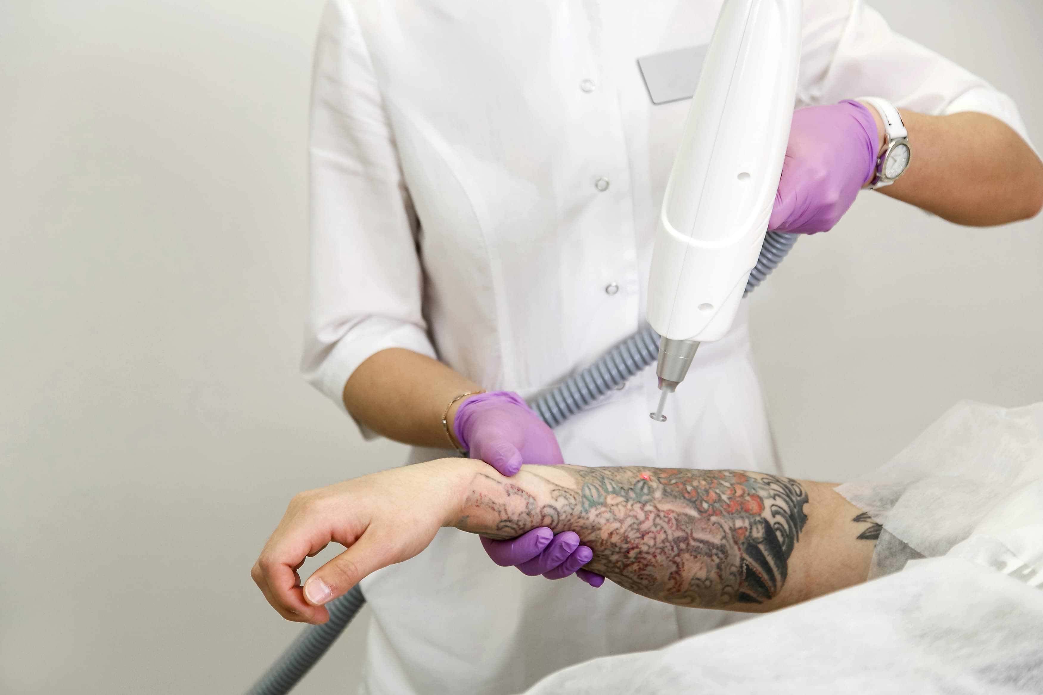 Laser Tattoo Removal